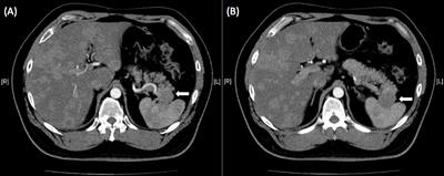 Everolimus Related Fulminant Hepatitis in Pancreatic Neuroendocrine Tumor With Liver Metastases: A Case Report and Literature Review